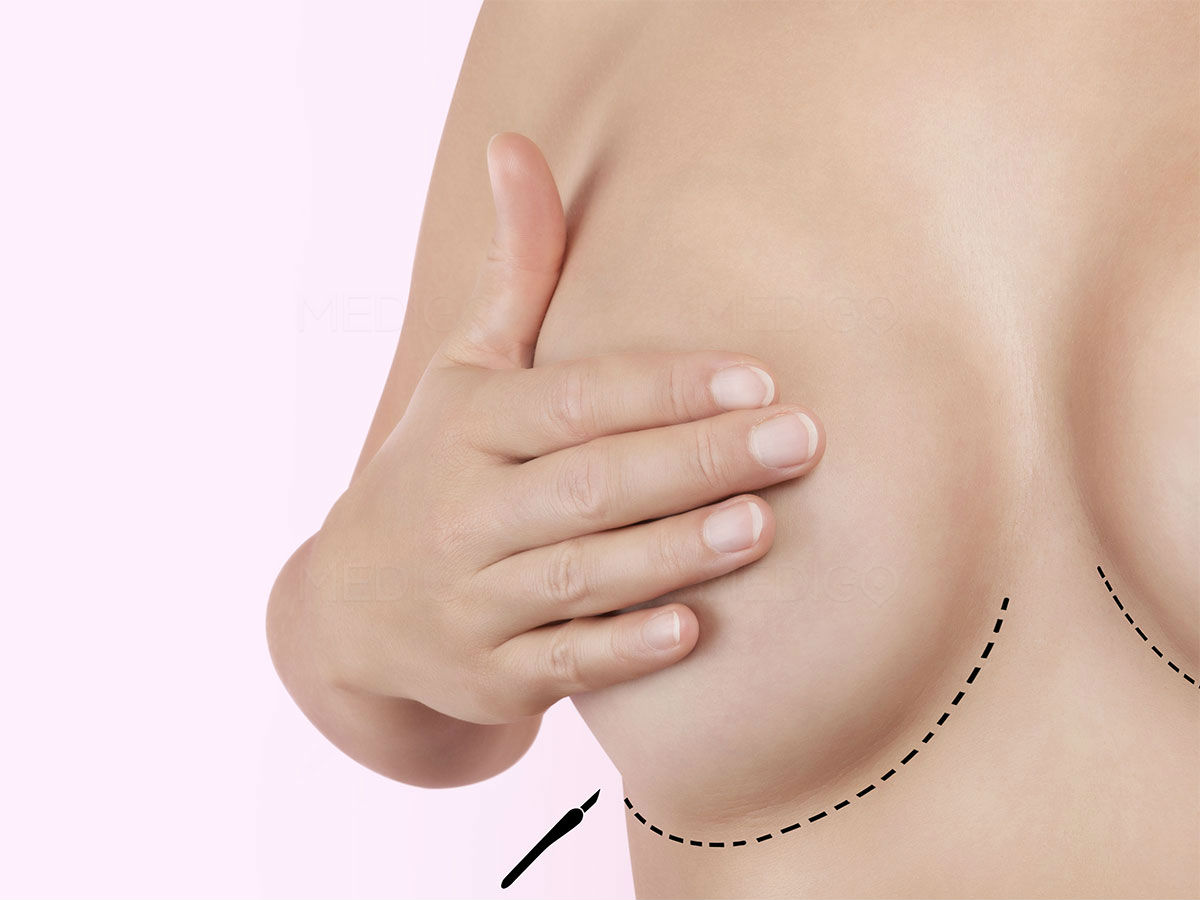 Breasts: Breast Implant Removal Surgery